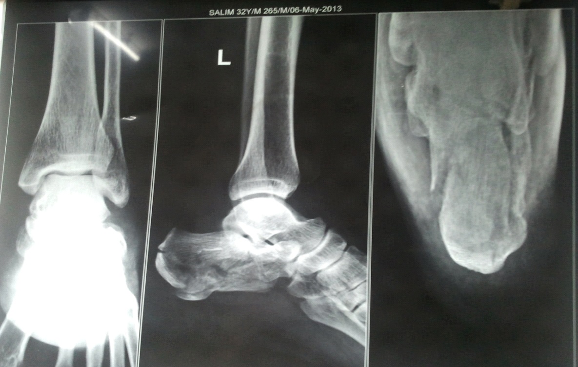 Measuring standing hindfoot alignment: reliability of different approaches  in conventional x-ray and cone-beam CT | Archives of Orthopaedic and Trauma  Surgery