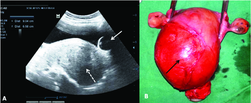 How Fibroids Are Measured