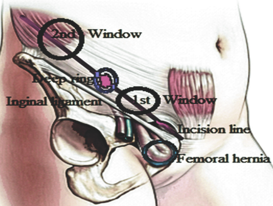 Open femoral hernia repair: one skin incision for all