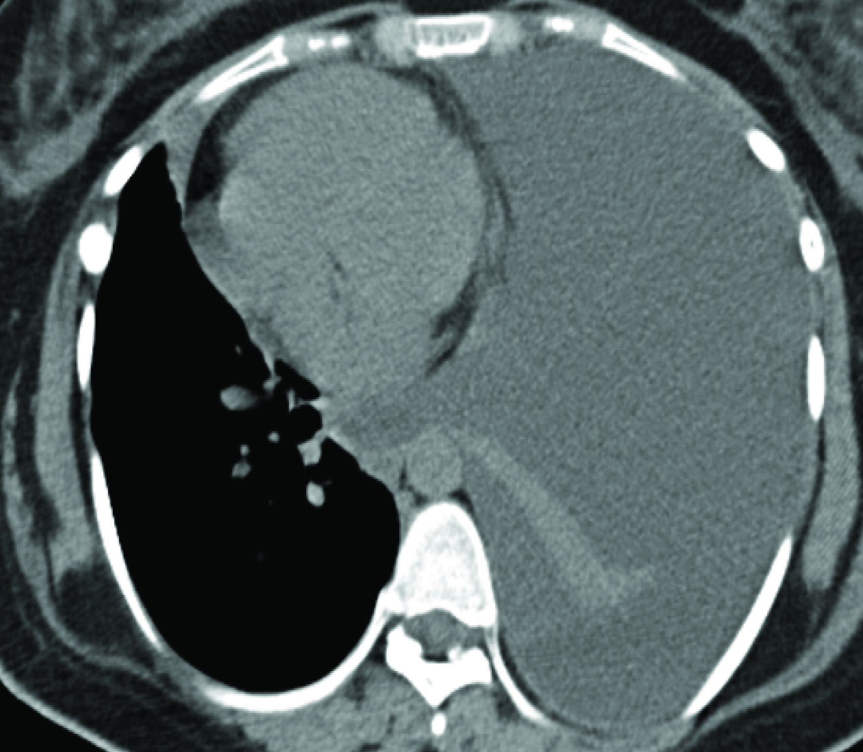 CT Scan Left Pleural Effusion.