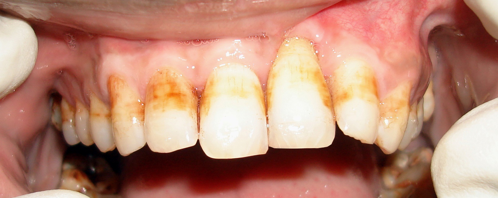 Single Recession Defect Nine month post-operative radiograph.