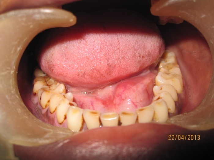 Jcdr Salivary Gland Pathology Sialolithotomy Salivary Stone