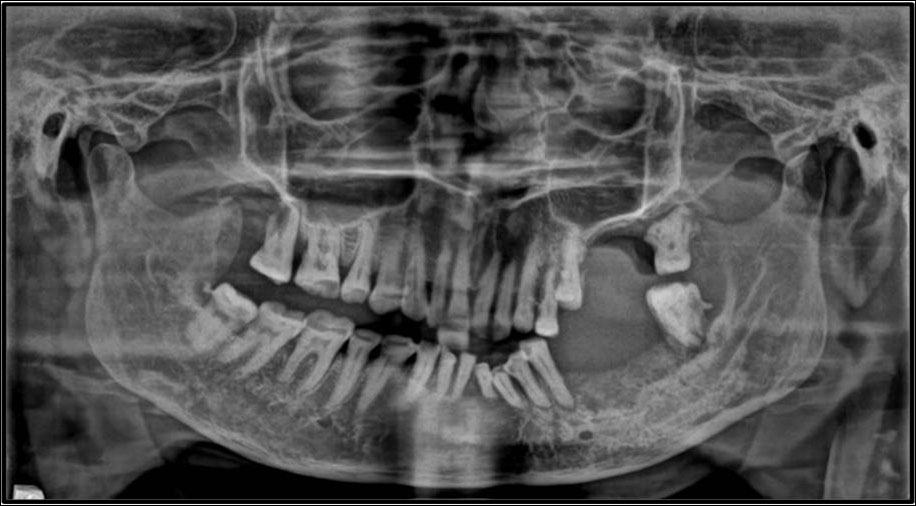 Orthopantomograph Showing Irregular Lytic Lesion With Jagged Edges In