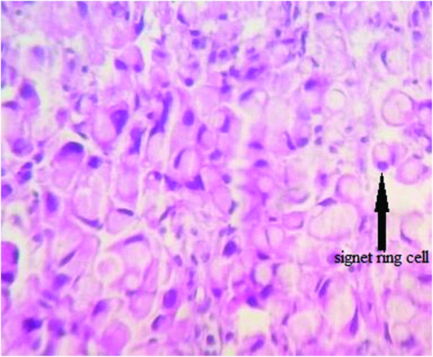 SSAT - INCIDENCE, SURVIVAL, AND PREDICTORS OF LYMPH NODE METASTASIS IN  EARLY STAGE GASTRIC SIGNET RING CELL CARCINOMAS IN THE UNITED STATES