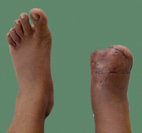 Functional Prosthetic Silicone Feet And Toes, foot at Rs 25000 in New Delhi
