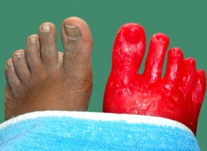 Functional Prosthetic Silicone Feet And Toes, foot at Rs 25000 in New Delhi