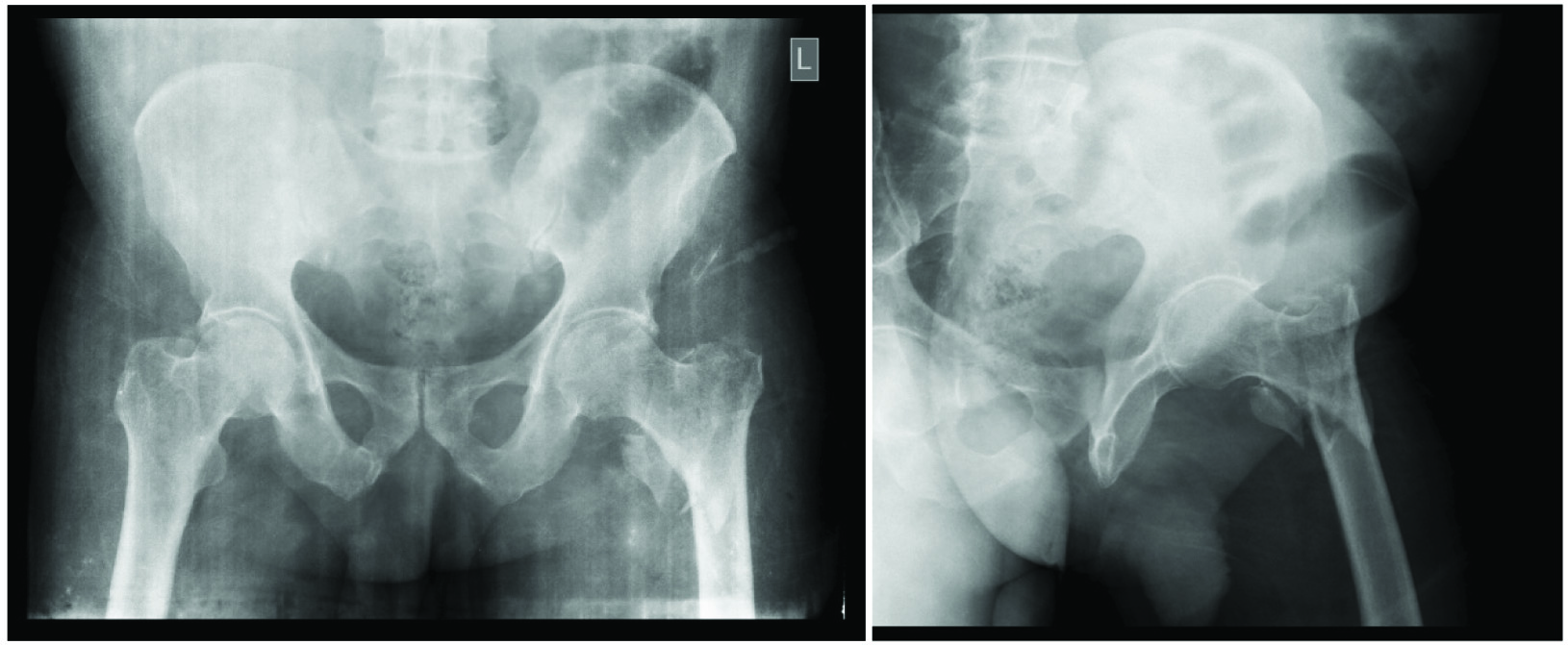 One‐Stage Closed Intramedullary Nailing for Delayed Femoral Fracture in  Multiple Injured Patients - Yan - 2022 - Orthopaedic Surgery - Wiley Online  Library