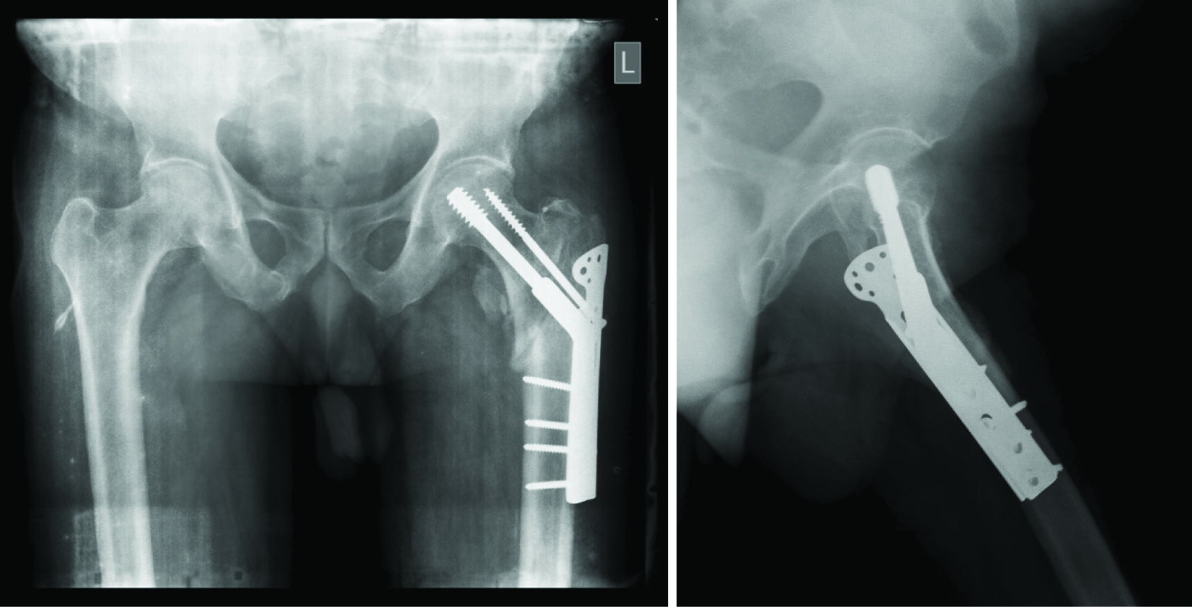 Complications After Hip Nailing for Fractures | Orthopedics