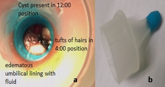 Periungual pilonidal sinus  Pui G Ngan Alex HR Varey Ajay L Mahajan 2011