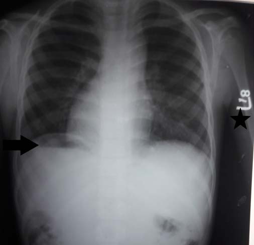 Chest radiograph showing dextrocardia and situs inversus totalis. Arrow ...