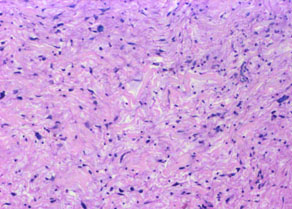 JCDR - Floret giant cells, Ropey collagen, Soft tissue neoplasm