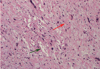 JCDR - Floret giant cells, Ropey collagen, Soft tissue neoplasm