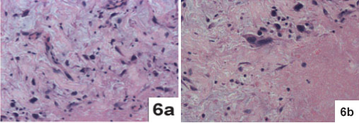 JCDR - Floret giant cells, Ropey collagen, Soft tissue neoplasm