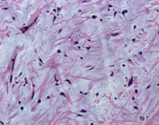 JCDR - Floret giant cells, Ropey collagen, Soft tissue neoplasm