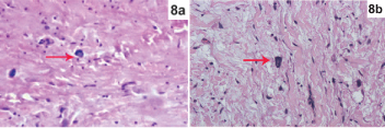 JCDR - Floret giant cells, Ropey collagen, Soft tissue neoplasm
