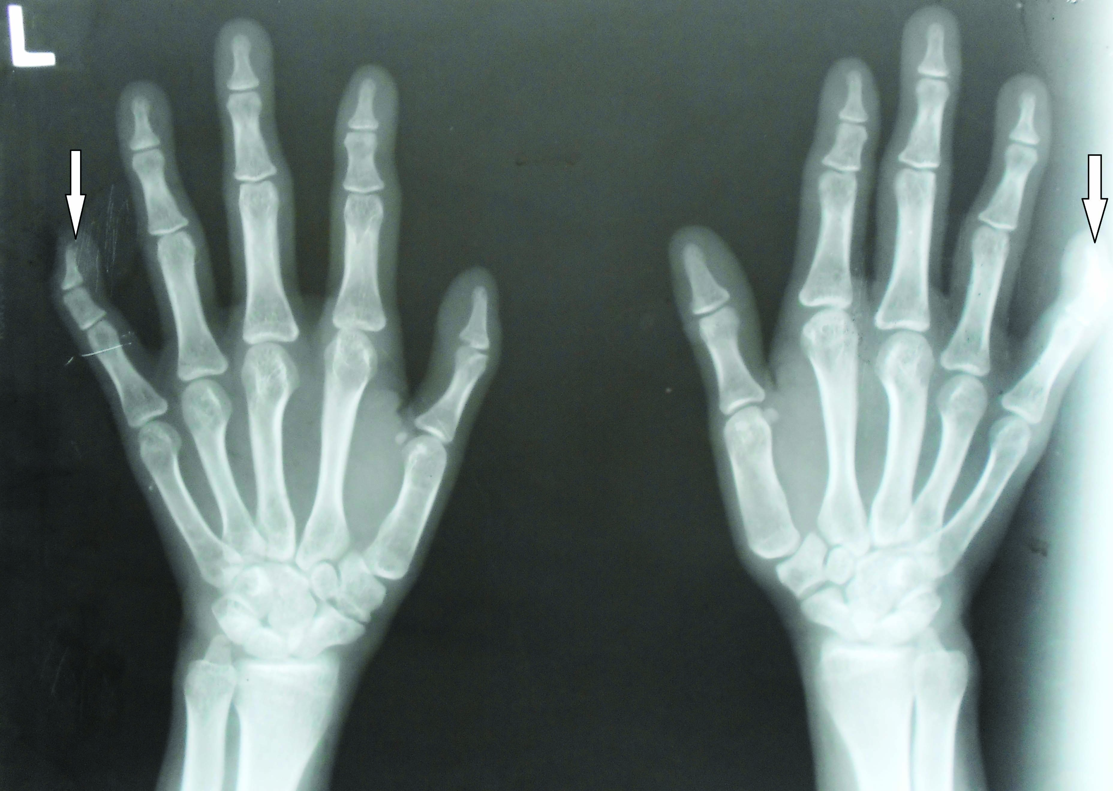 Rubinstein - Taybi Syndrome (Rubinstein syndrome, broad thumb