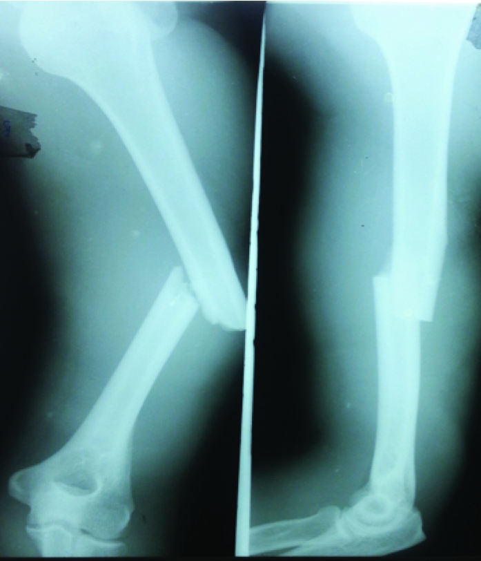 Retrograde Humeral Nail for treatment of an isolated femoral shaft fracture  in a patient with Mucolipidosis Type IV: Surgical decision making and  outcome