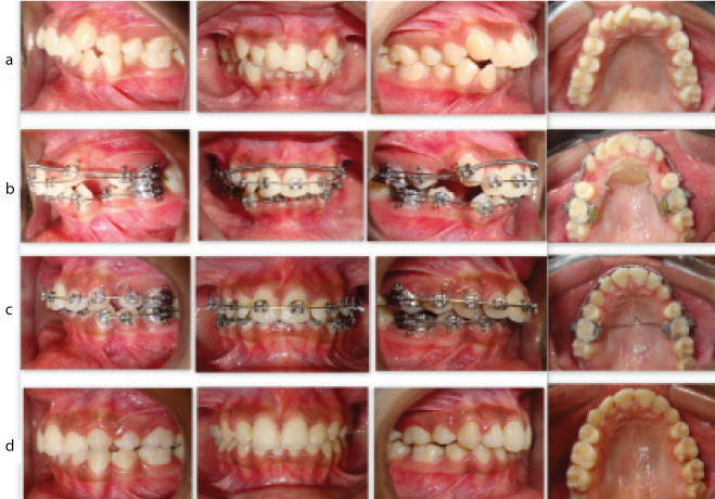 JCDR - Alignment, Canine lacebacks, Incisor crowding, Open coil