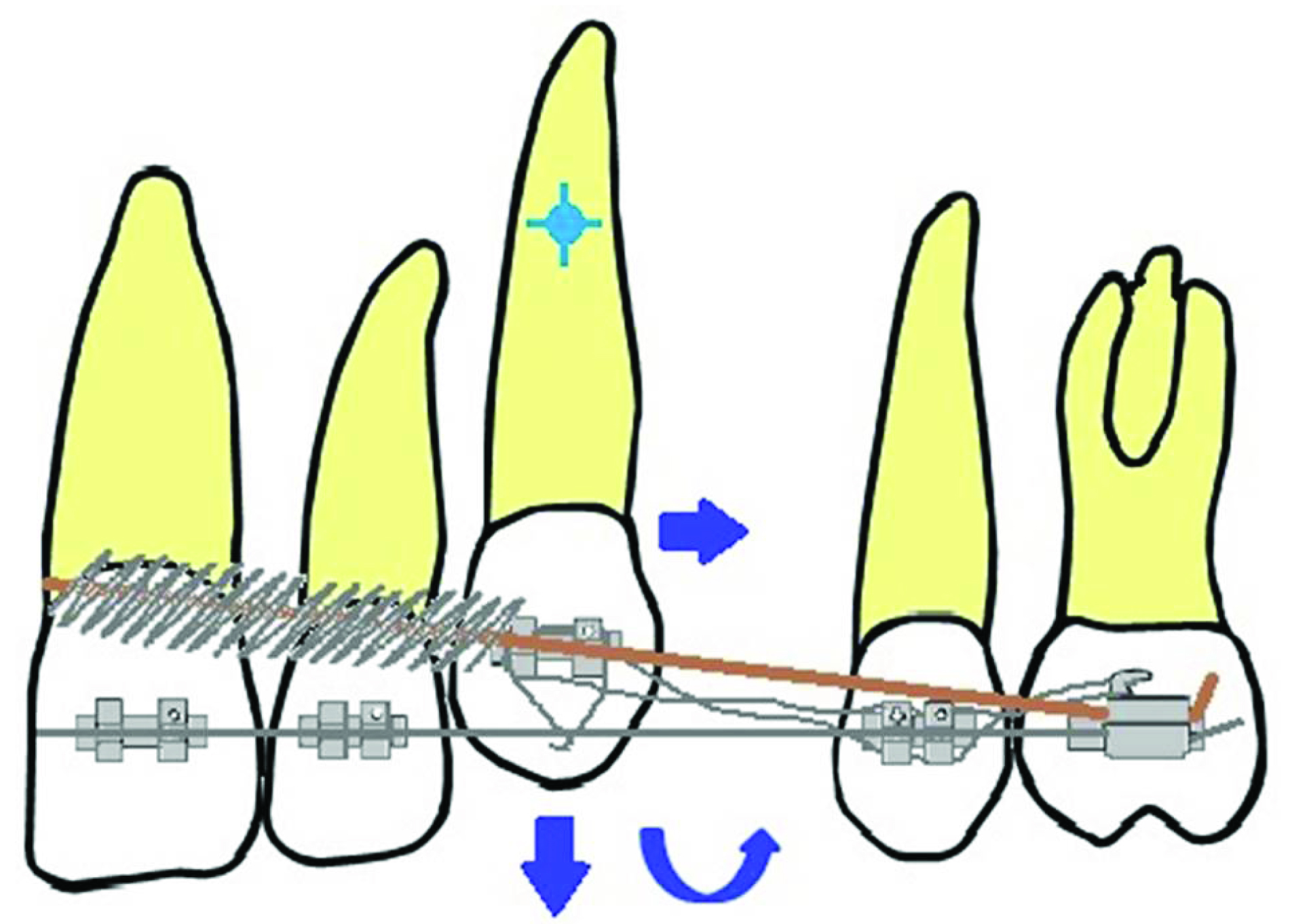 JCDR - Alignment, Canine lacebacks, Incisor crowding, Open coil springs,  Sliding mechanics