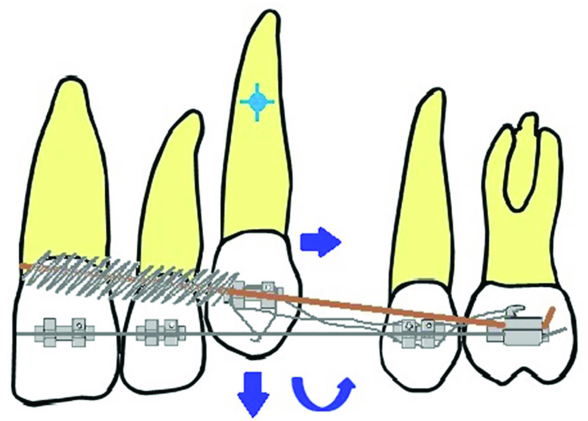 PDF) Effectiveness of Laceback Ligatures on Maxillary Canine