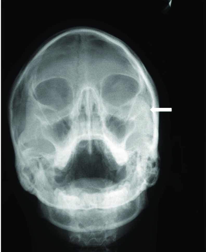 Zygomatic Process Of Maxilla Radiology
