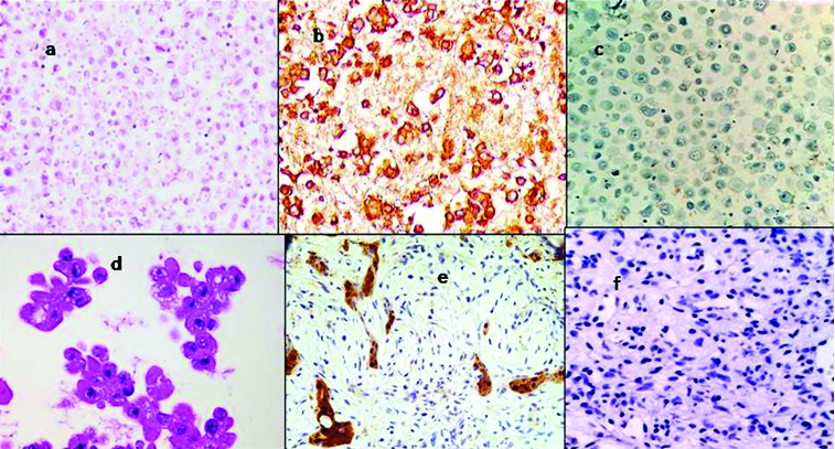 can blood test diagnose bowel cancer