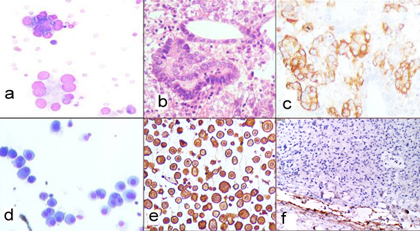 malignant pleural effusion exudative