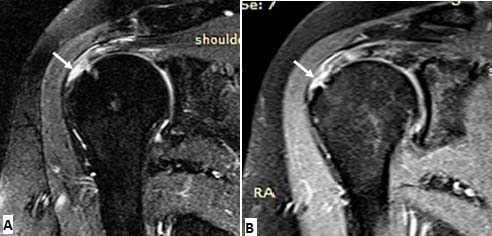 supraspinatus tear mri